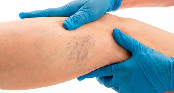 Pilihan Pengobatan Varises: Dari Terapi hingga Prosedur Medis